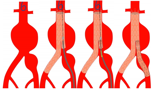 Endovaskulärer Eingriff