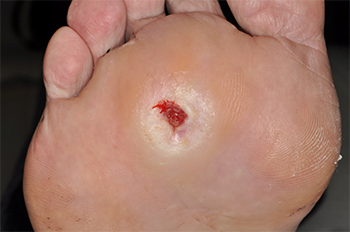 Typisches Druckulcus am Fußballen bei Diabetes mellitus