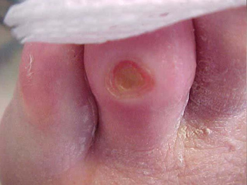 Ulcus an der 4. Zehe bei Diabetes mellitus