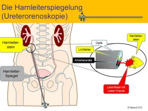 harnleiterspiegelung-zur-steinbehandlung-e0