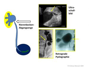 nierenbeckenabgangsenge-de