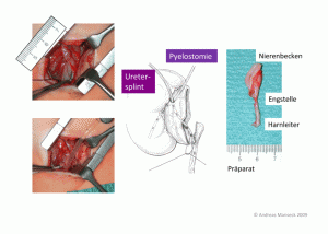 nierenbeckenabgangsenge-op-nach-anderson-heynes-22