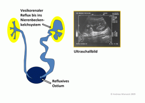 vesikorenaler-reflux-ad