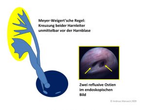 vesikorenaler-reflux-bei-ureter-duplex-46
